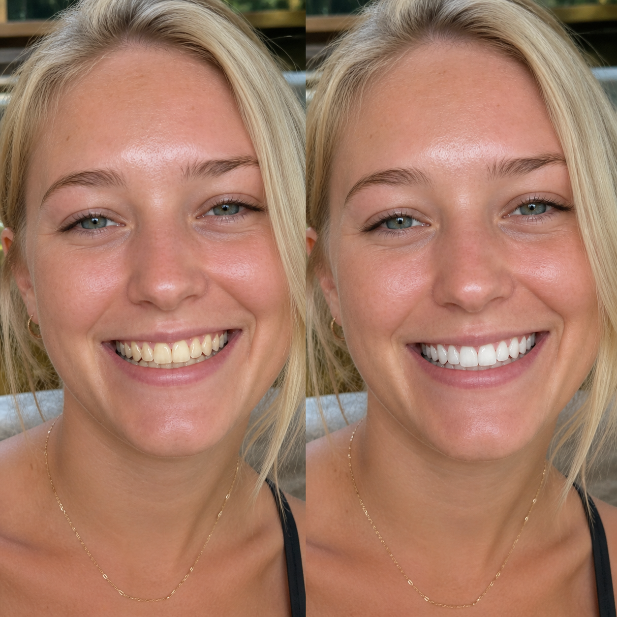 Before and after teeth whitening results