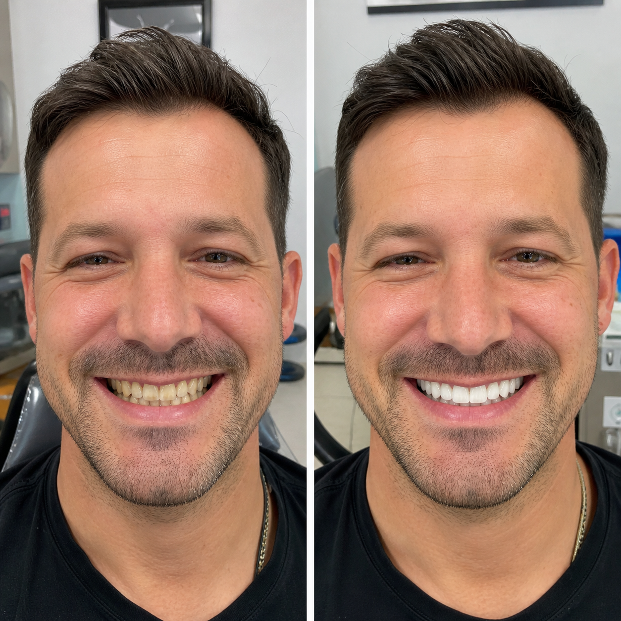 Before and after teeth whitening results